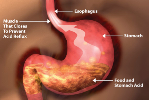 showing how stomach acid can flow into esophagus - acid reflux